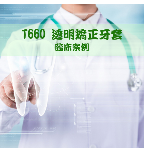 T660透明矯正牙套臨床案例